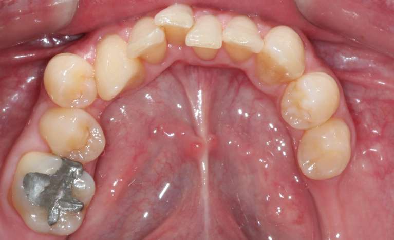 crooked teeth before treatment | cosmetic dentist goffstown nh